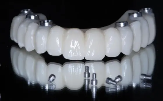 Arcada de circonio sobre implantes con los tornillos de fijación