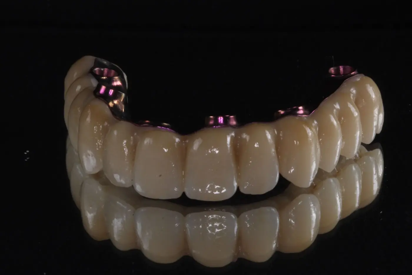 Arcada completa atornillada sobre implantes vista de frente