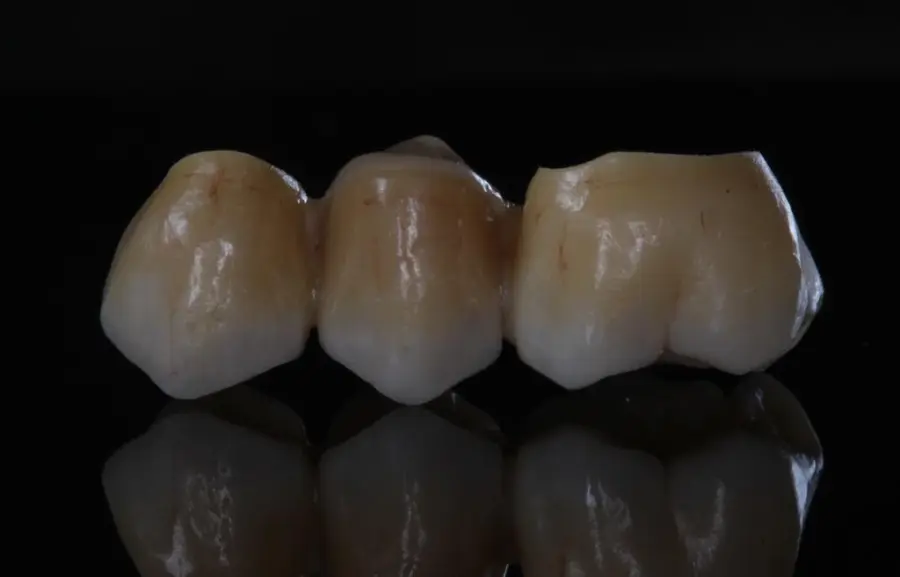 Tres coronas de cerámica con su reflejo